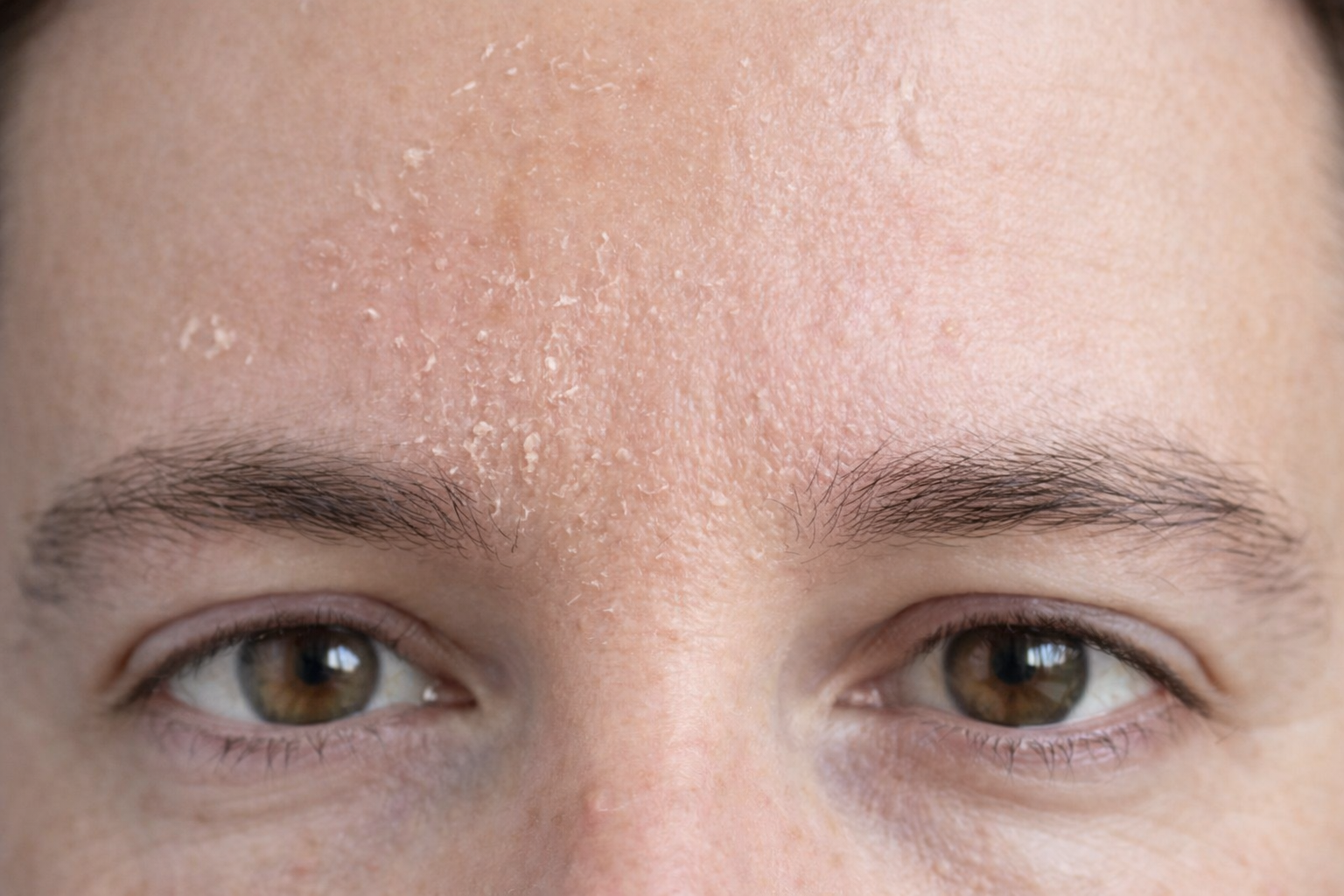 Peeling medio en piel facial