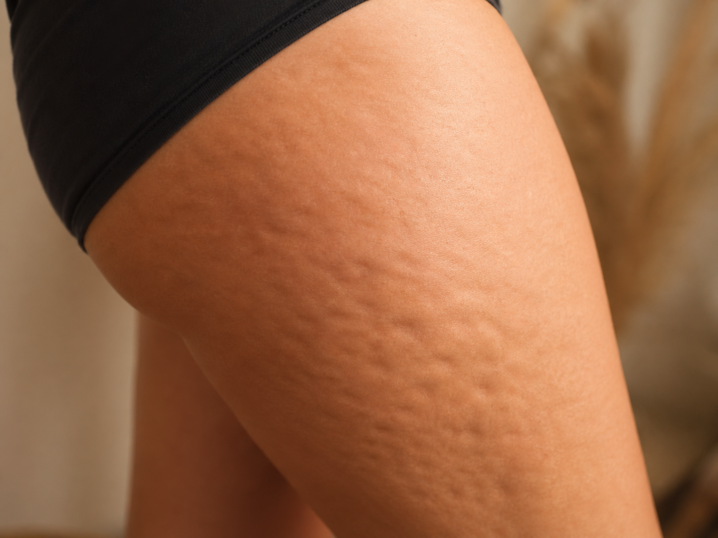 ALIDYA para celulitis