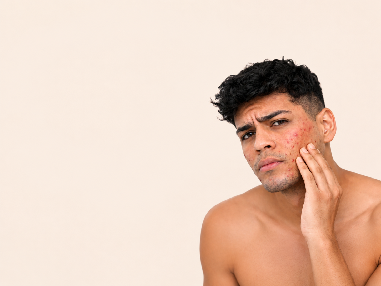 acne-rosacea-y-manchas-en-madrid