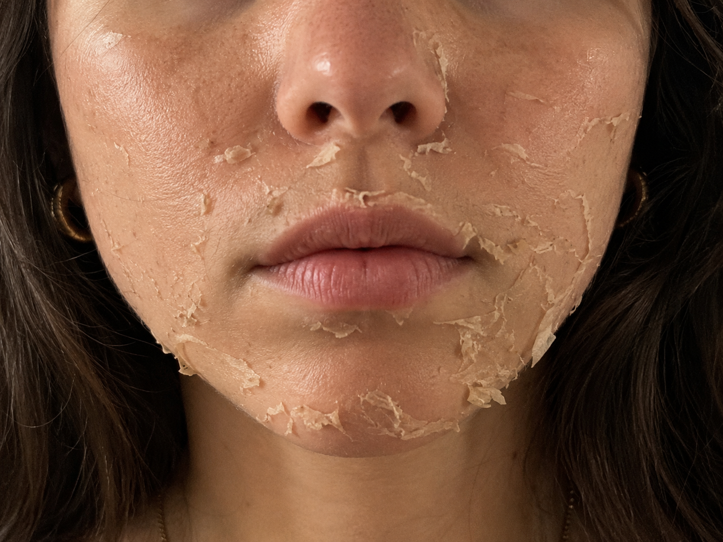 rejuvenecimiento facial Madrid con peeling químico