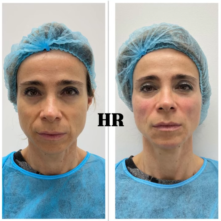 Tratamiento Full Face antes y después en HRocha