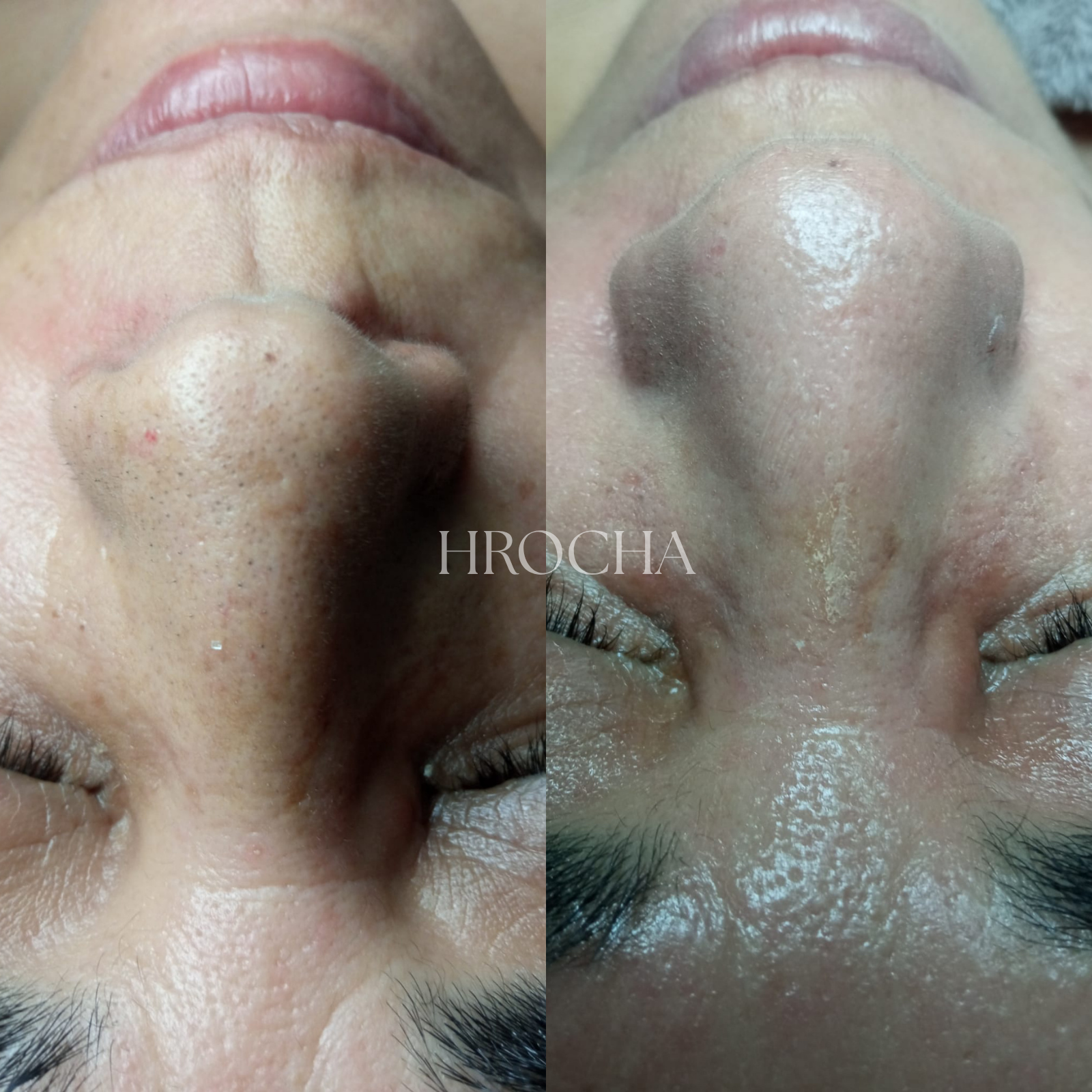 Higiene facial con extracción y limpieza de poros en HRocha