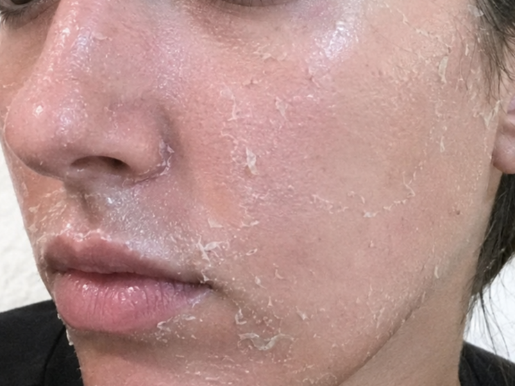 Peeling profundo en piel facial