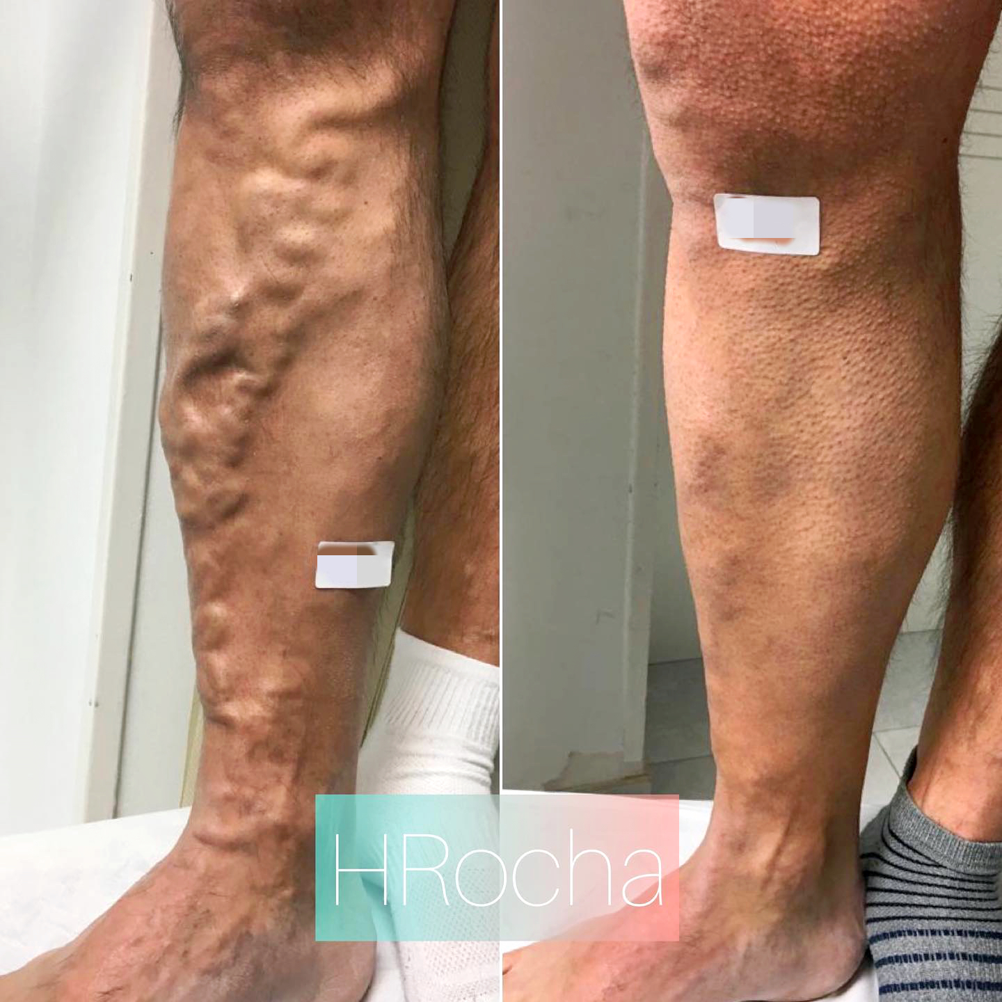 Resultado de tratamiento de varices tronculares con escleroterapia con espuma