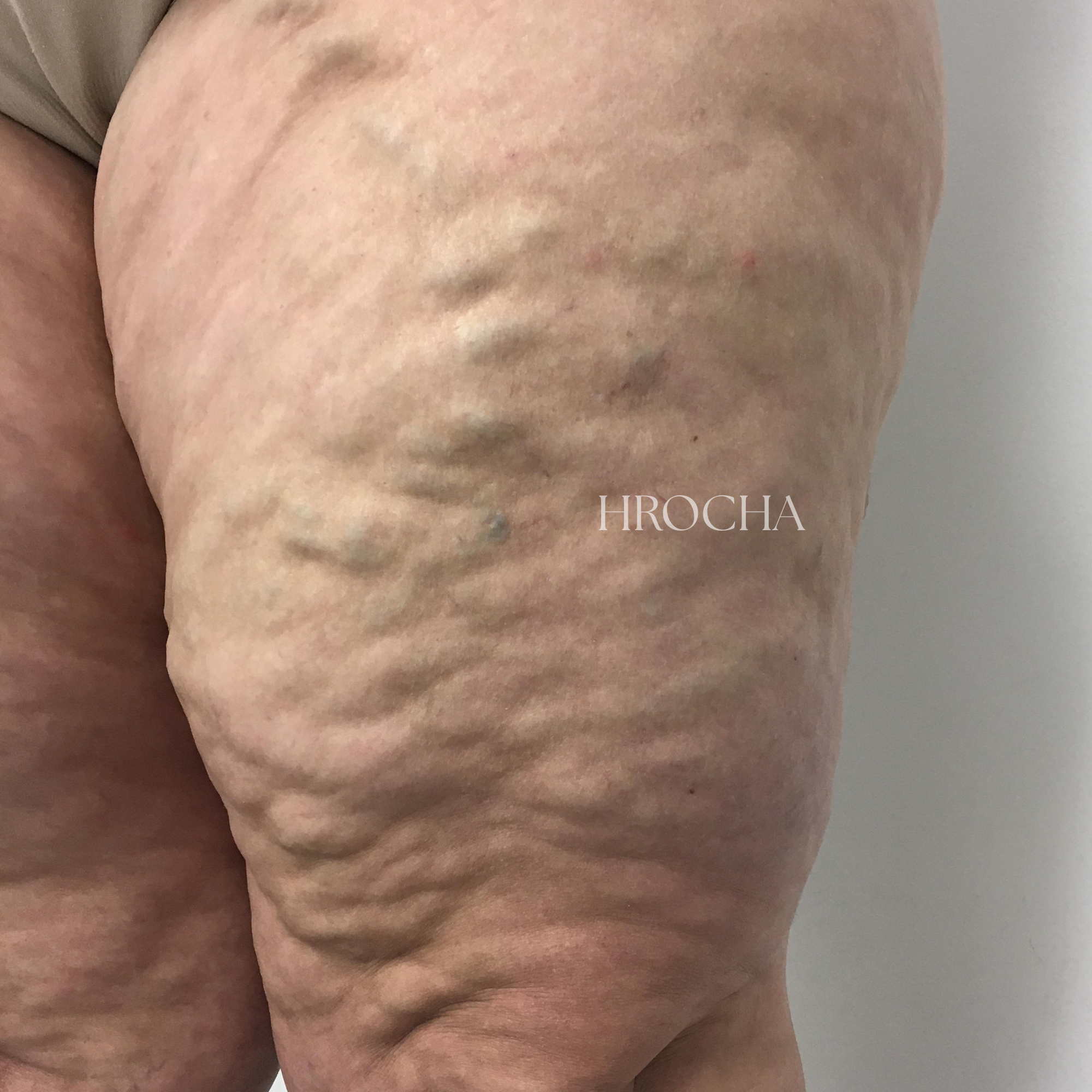 Varices tronculares