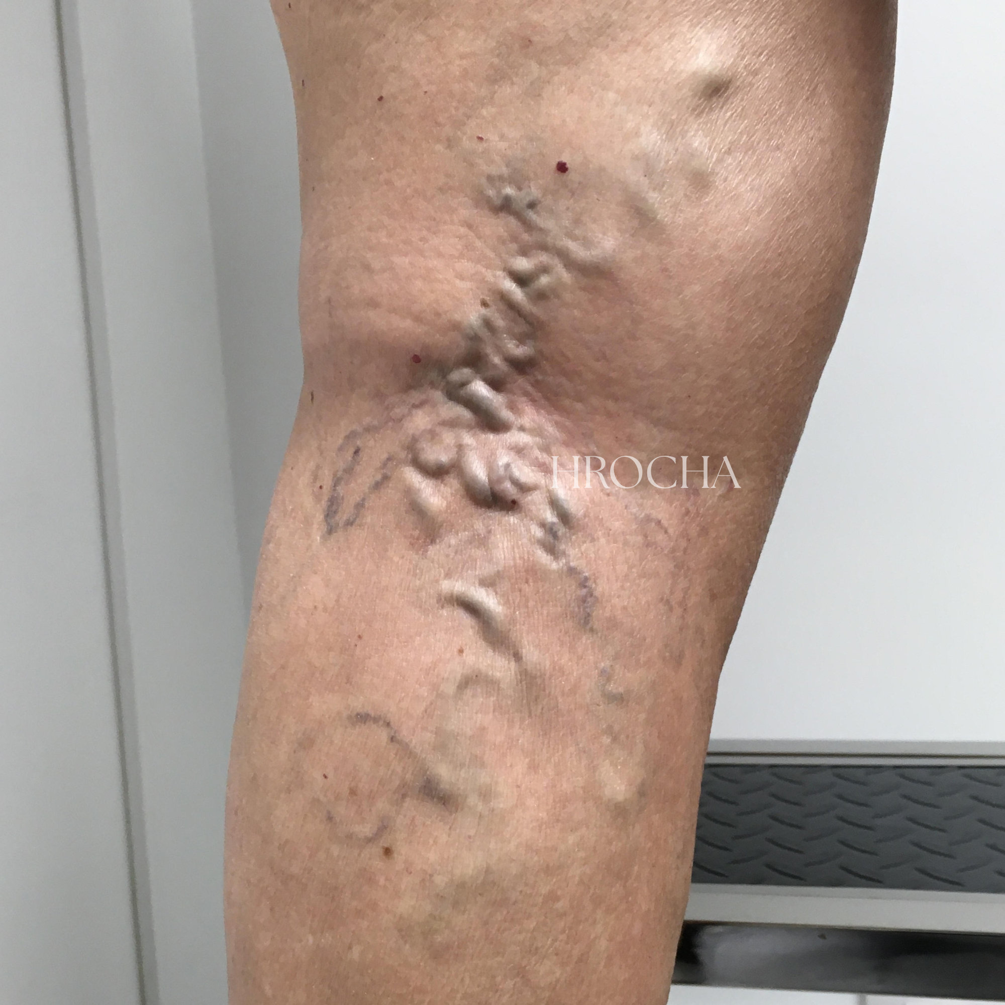 Varices tronculares visibles en pierna