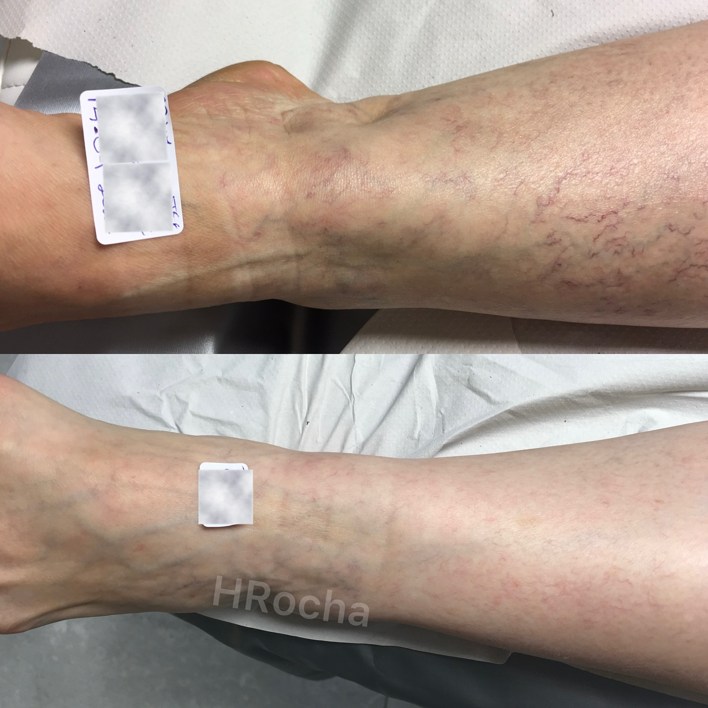 Resultado de tratamiento de telangiectasias y varices reticulares con crioesclerosis