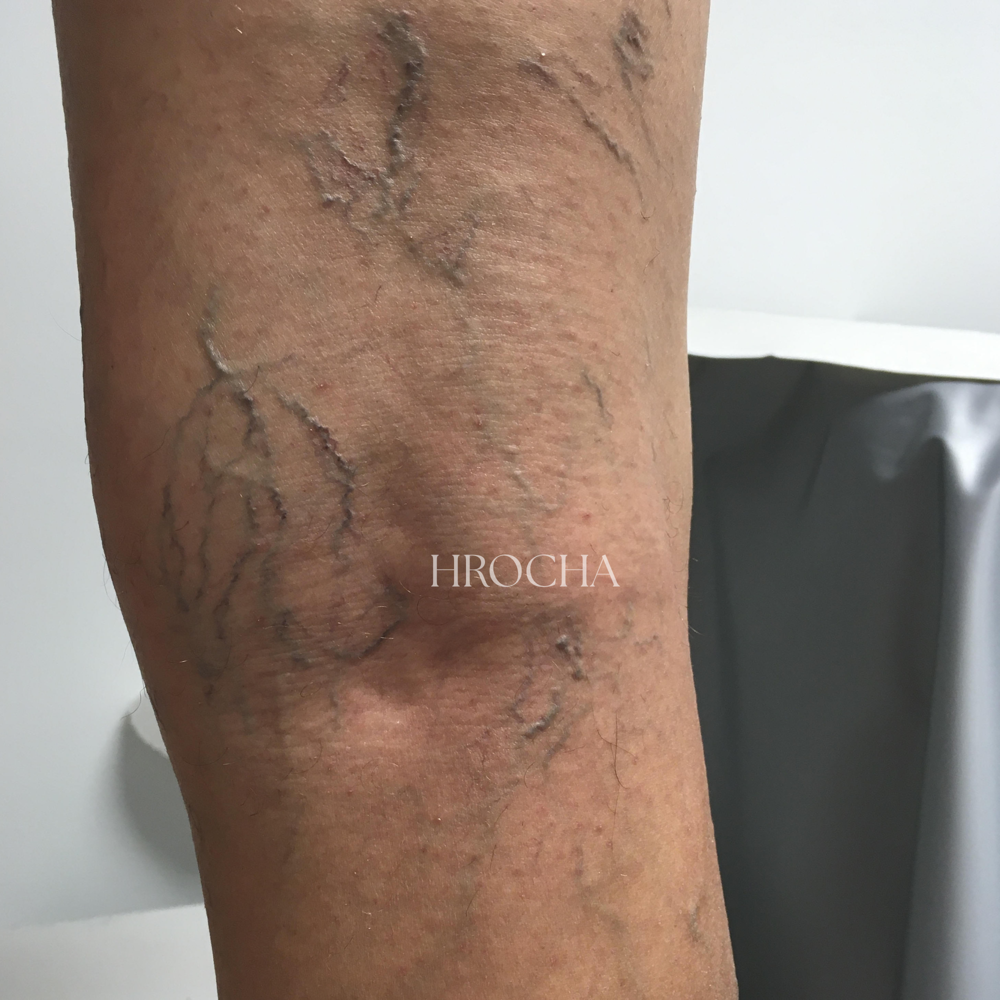 Telangiectasias y varices reticulares tratadas con crioesclerosis IZQUIERDA