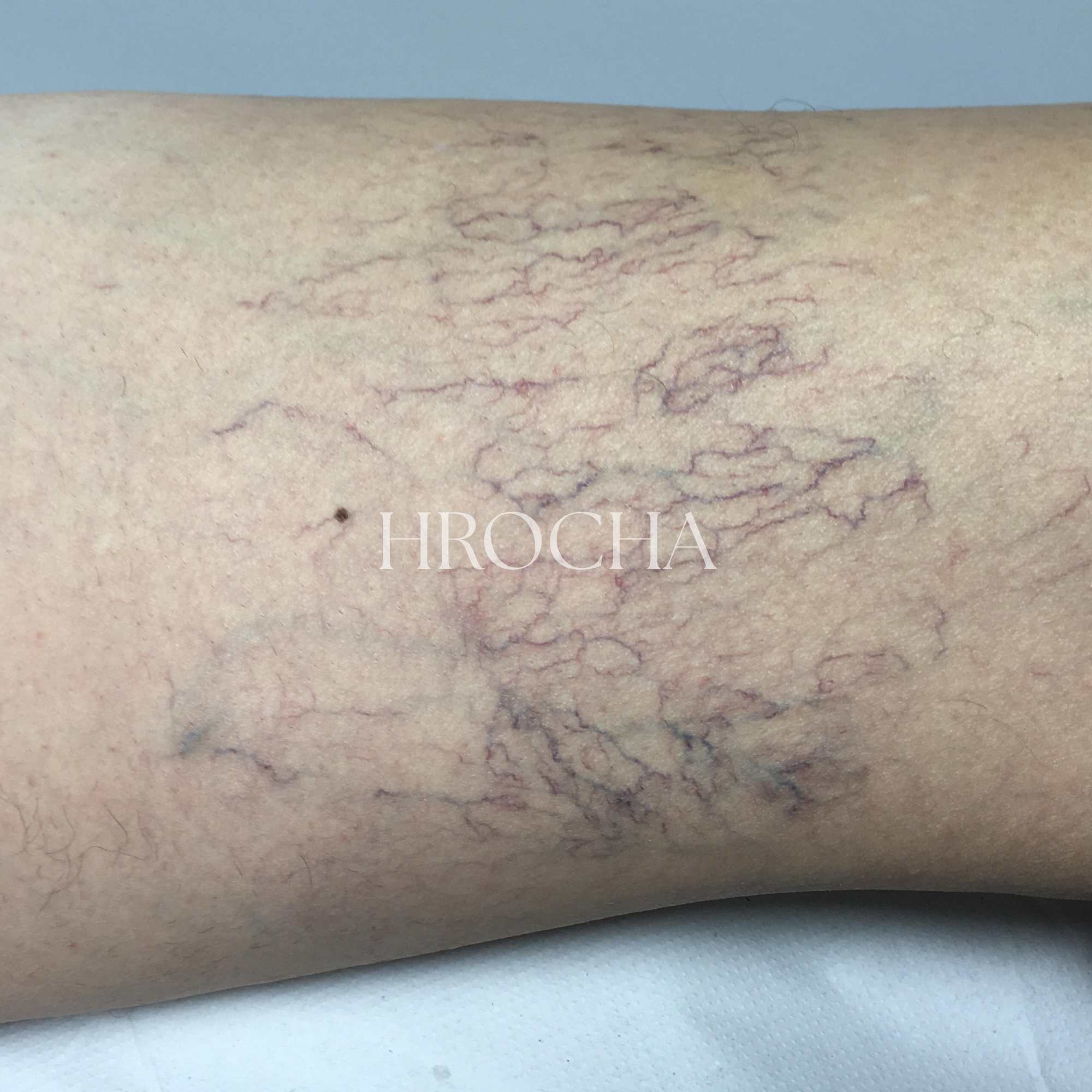 Telangiectasias y varices reticulares tratadas con crioesclerosis
