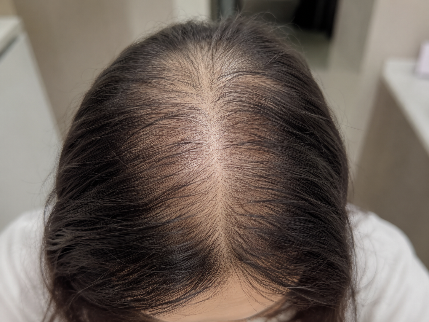Tratamiento para la caída del cabello posparto