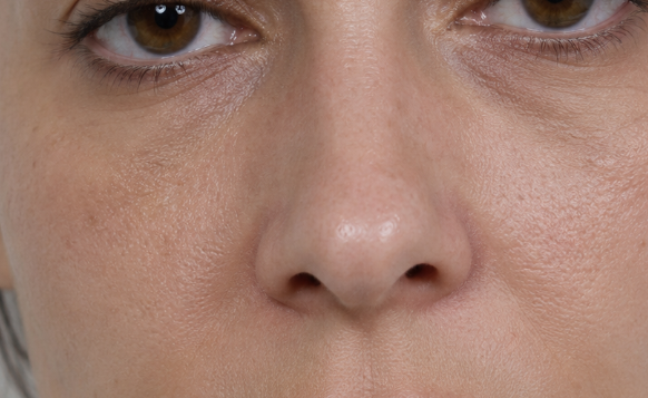 Tratamientos faciales para la recuperación posparto