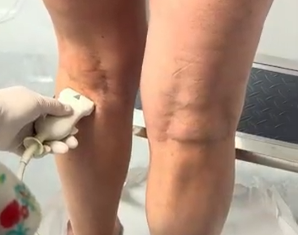 Eco Doppler para varices